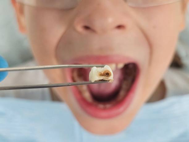 Best Emergency Treatment for Dental Infections or Abscesses in River Rouge, MI